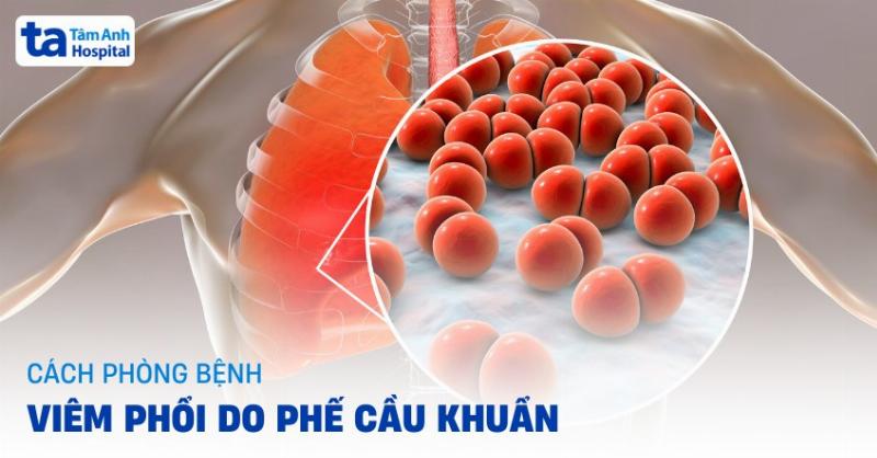 Cac bien phap phong ngua viem phoi hieu qua rua tay va tiem vac xin